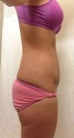 How to Losie weight after tummy tuck and lipo