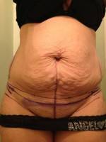 How to remove umbilical hernia with tummy tuck