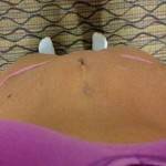 Losing weight after tummy tuck and lipo photos