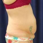 Losing weight after tummy tuck and lipo pictures