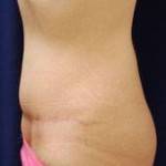 Losing weight after tummy tuck and lipo scar