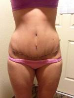 Losing weight after tummy tuck and lipo scar after surgery