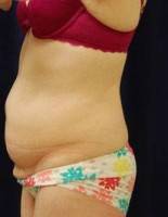 Losing weight after tummy tuck and liposuction