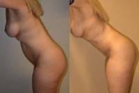 Photo before after tummy tuck umbilical hernia