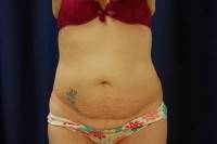 Photos of losing weight after tummy tuck and lipo