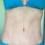 Standard tummy tuck of belly button scar pictures