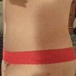 Standard tummy tuck with lipo surgery pictures