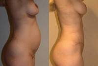 Tummy tuck umbilical hernia before and after