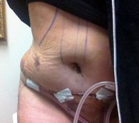 Pain pump after tummy tuck abdominoplasty