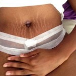 Pregnancy stretch marks tummy tuck scar strips