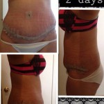 Reverse tummy tuck before and after 2 weeks 2 days