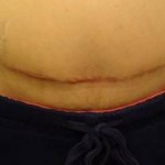 Reverse tummy tuck before and after abdominoplasty