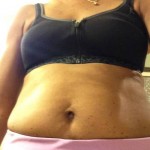 Standard tummy tuck pictures blogs shapshot