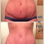 Standard tummy tuck pictures plastic surgery