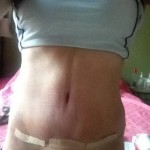 Swelling 1 year after tummy tuck abdominoplasty
