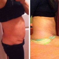Swelling 1 year after tummy tuck  before and after