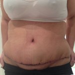 Swelling 1 year after tummy tuck images