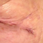Swelling 1 year after tummy tuck scar
