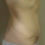 Tummy tuck estimated cost for surgery