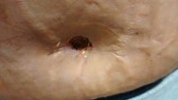 What is endoscopic tummy tuck pictures
