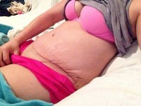 Photo after double mastectomy and tummy tuck surgery