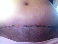 Photo of fatty necrosis tummy tuck