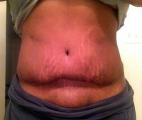 Picture after abdominoplasty after mastectomy