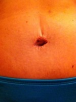 The photo of healing of belly button after abdominoplasty