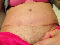 Tummy tuck after mastectomy scar