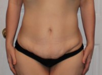 Abdominoplasty picture of muscle plication during surgery