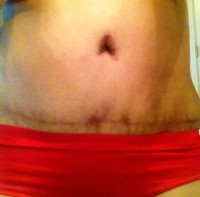 Belly button size and shape after tummy tuck