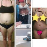 Photo of tummy tuck candidate before and after