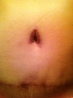 The size and shape of belly button after abdominoplasty photo