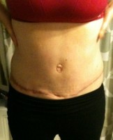 A low placed tummy tuck