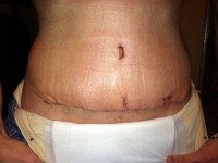 A scar after standart abdominoplasty