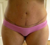 The scar after full abdominoplasty