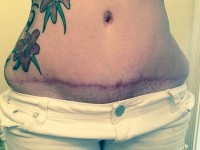 tummy tuck covered by insurance after pregnancy photo