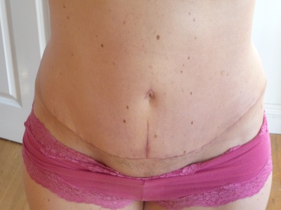 tummy tuck insurance paid