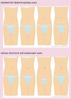 tummy tuck scar position types