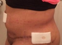 Second opinion and Tummy Tuck
