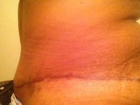 Abdominoplasty scar treatment