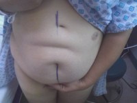 Tummy tuck surgery after  massive weight loss
