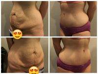 Before And After Tummy Tuck Without Drains