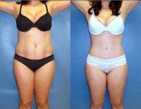 How Long Has Drainless Tummy Tuck Been Available