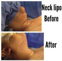 Neck Lipo Before And After By Dr Salzhauer
