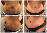 Tummy Tuck With No Drain Before And Aftre Photos