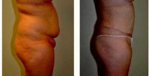 22 Year Old Woman Treated With Tummy Tuck By Doctor Jack Peterson, MD, Topeka Plastic Surgeon