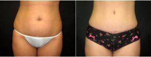 24 Year Old Woman Treated With Tummy Tuck With Dr John Paletta, MD, Savannah Plastic Surgeon