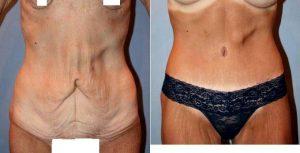 25 Year Old Woman Treated For Tummy Tuck With Dr Douglas Taranow, DO, FACOS, New York Plastic Surgeon