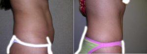 26 Year Old Woman Treated With Tummy Tuck By Doctor Gary Lawton, MD, FACS, San Antonio Plastic Surgeon
